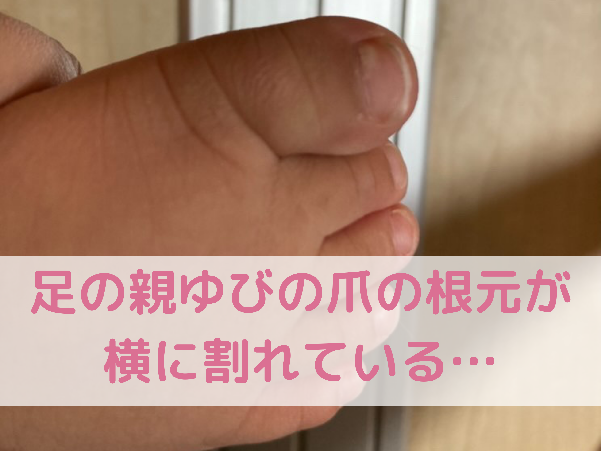 赤ちゃん 足 の 爪 割れる